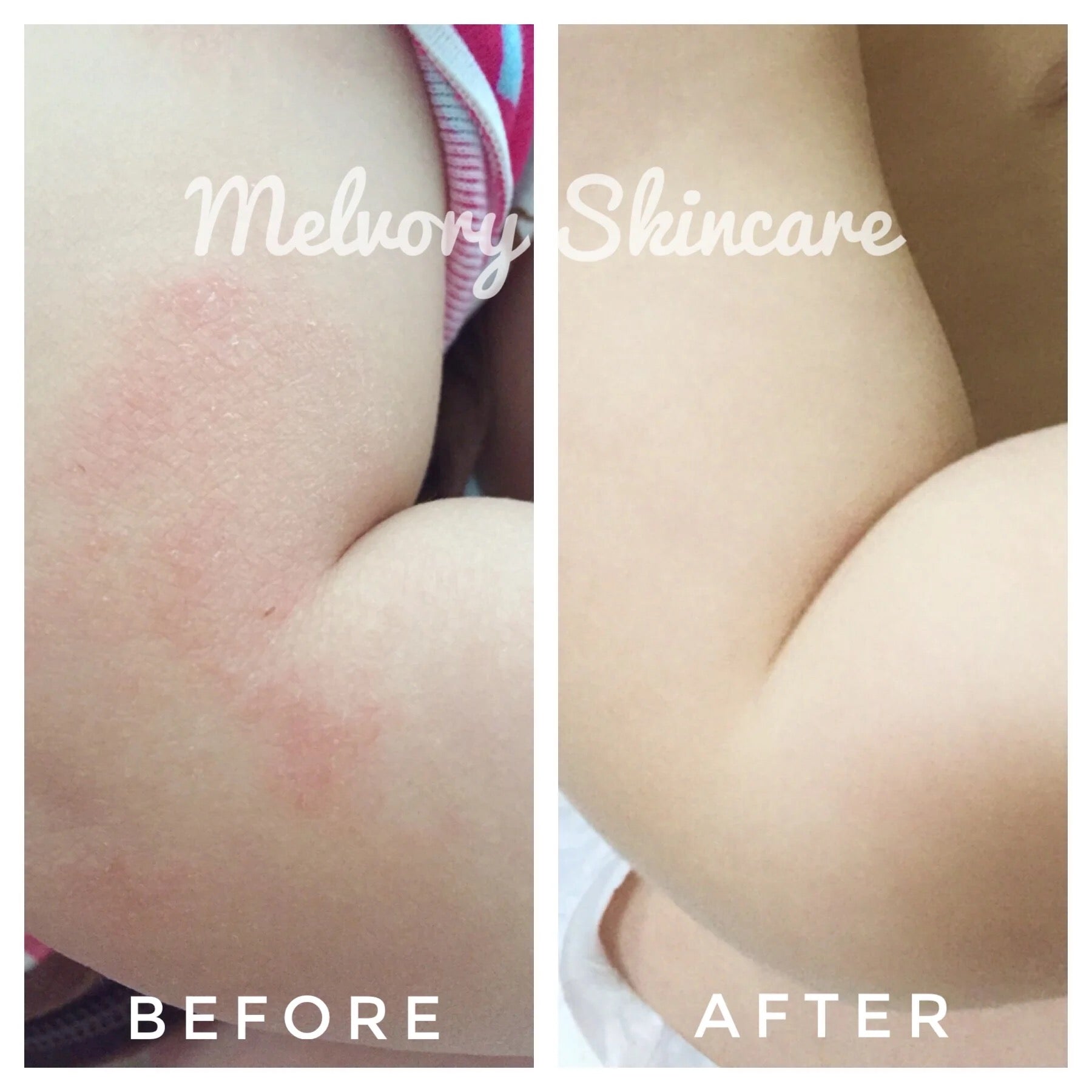 Before and after comparison of Melvory Skincare on a person's skin.