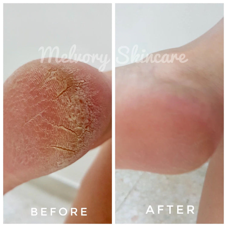 Before and after comparison of Melviny Skincare on a heel.