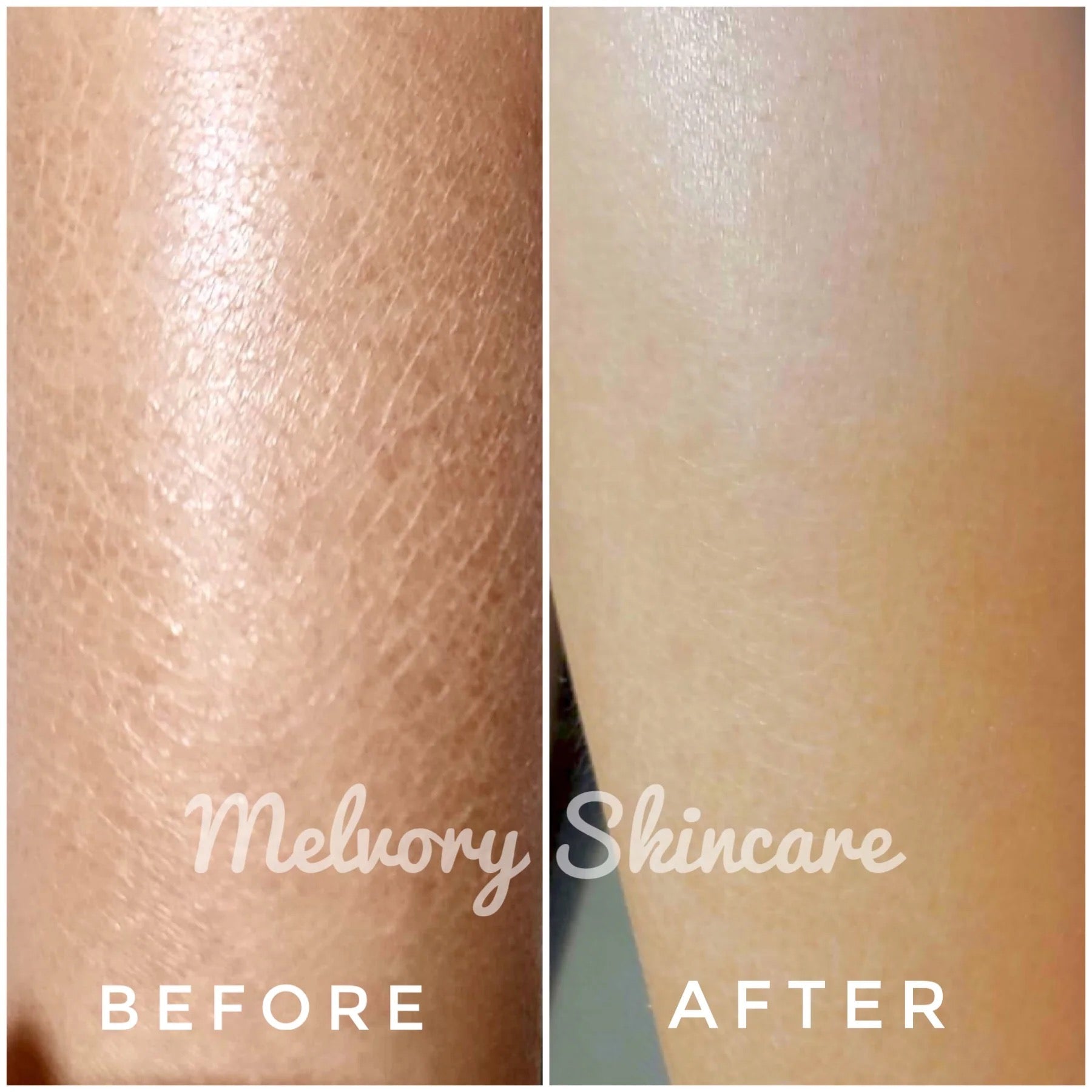 Before and after comparison of skin texture with Melvory Skincare branding.
